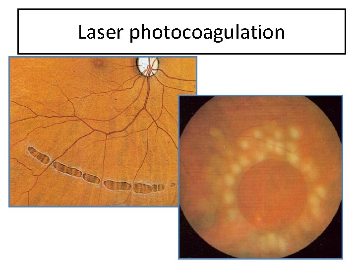 Laser photocoagulation 
