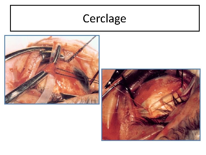 Cerclage 