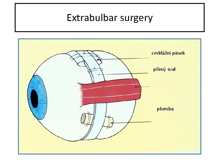 Extrabulbar surgery cerklážní pásek přímý sval plomba 