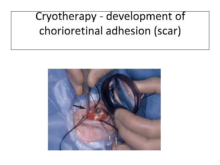 Cryotherapy - development of chorioretinal adhesion (scar) 