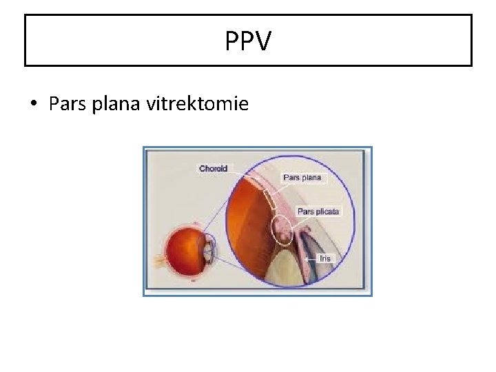 PPV • Pars plana vitrektomie 