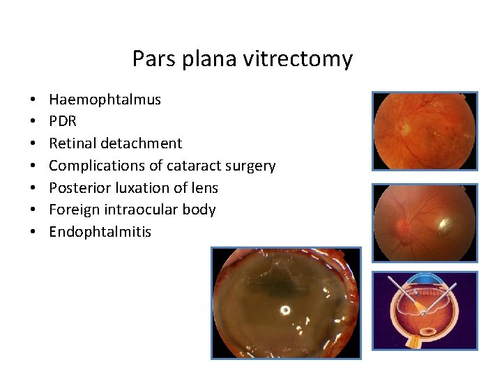 Pars plana vitrectomy • • Haemophtalmus PDR Retinal detachment Complications of cataract surgery Posterior