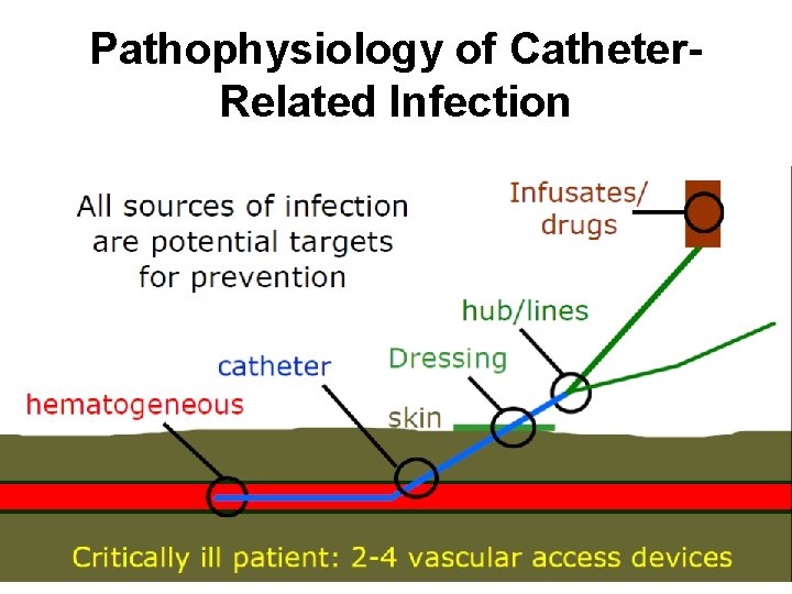 Impact of Primary BSI Pathophysiology of Catheter Related