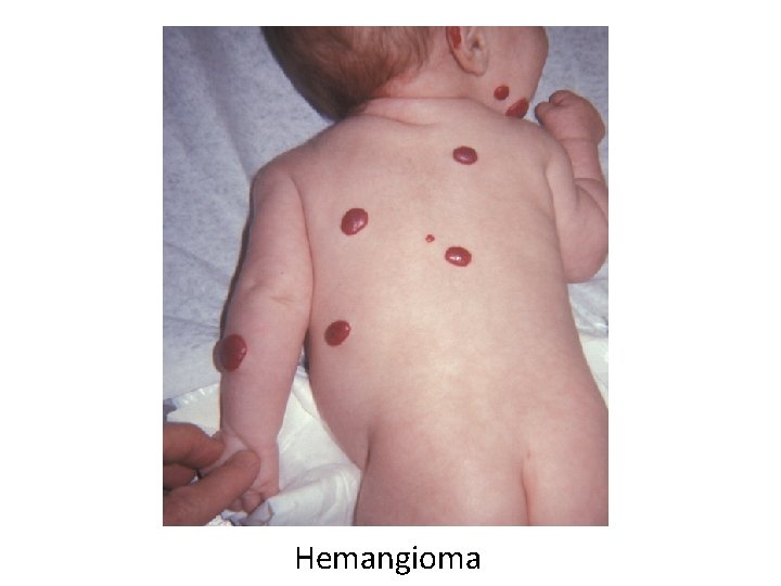 Hemangioma 