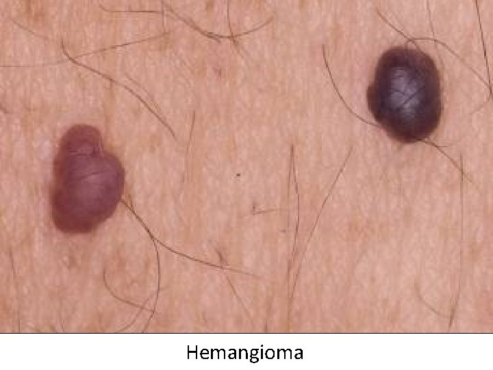 Hemangioma 