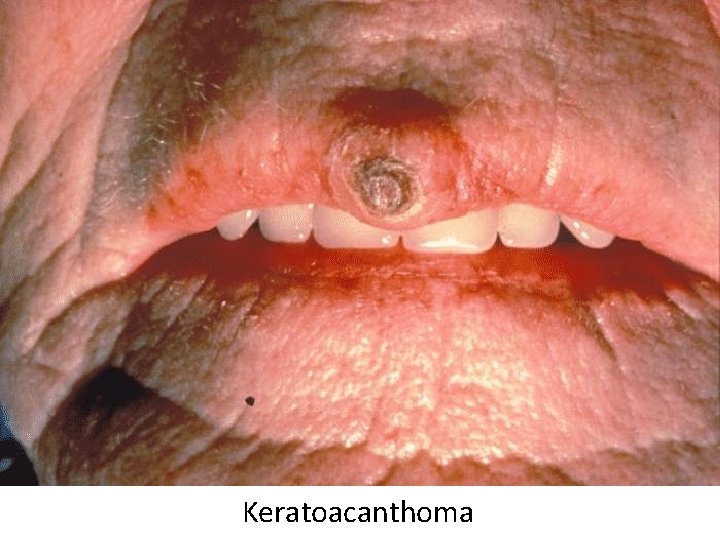 Keratoacanthoma 