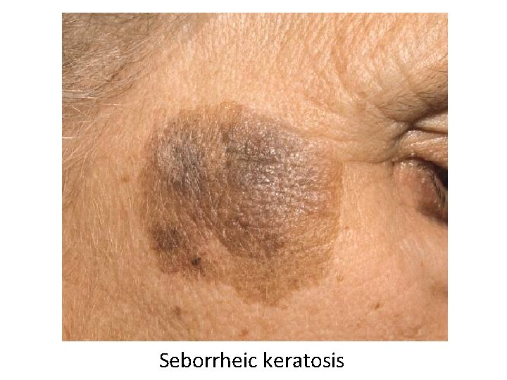 Seborrheic keratosis 