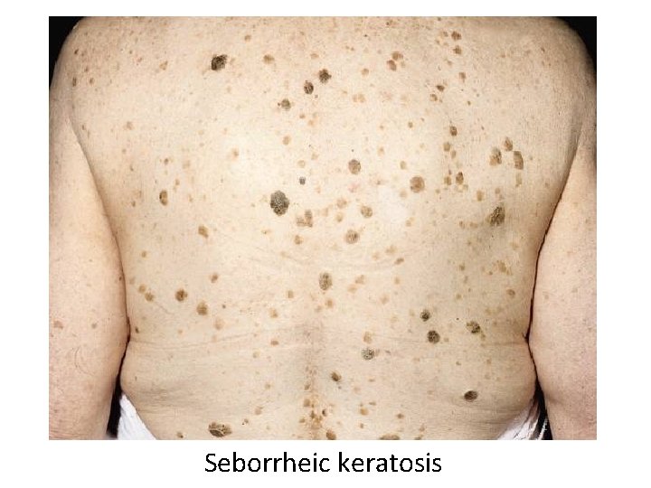 Seborrheic keratosis 