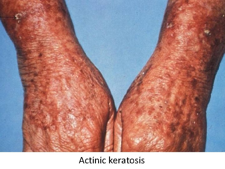 Actinic keratosis 