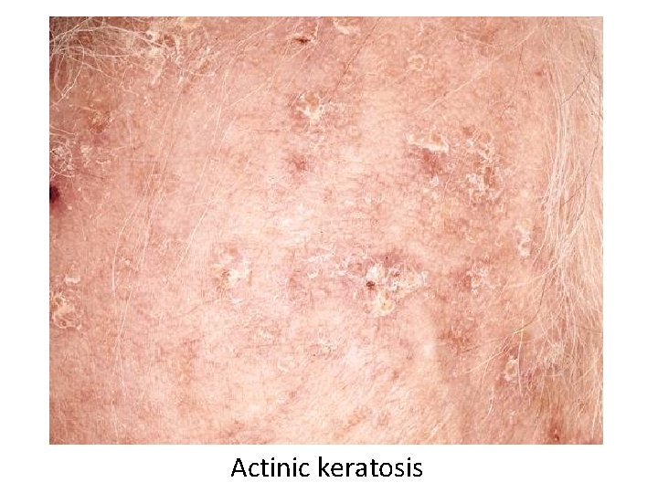 Actinic keratosis 