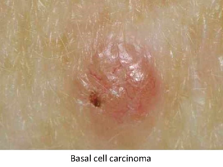Basal cell carcinoma 