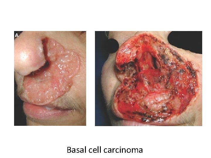 Basal cell carcinoma 