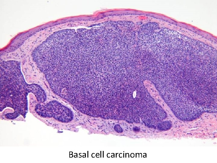 Basal cell carcinoma 