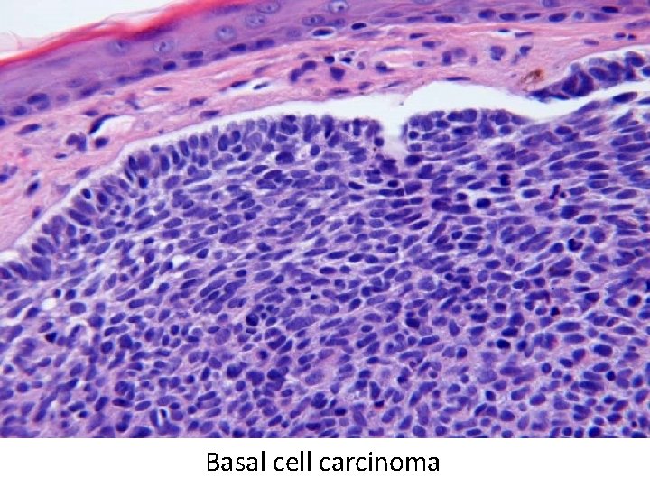 Basal cell carcinoma 