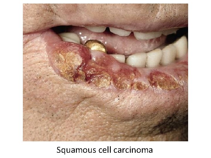 Squamous cell carcinoma 