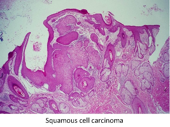 Squamous cell carcinoma 
