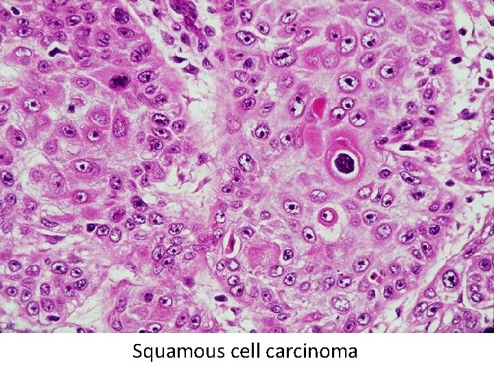 Squamous cell carcinoma 