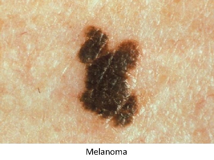 Melanoma 