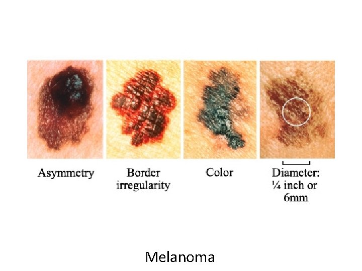 Melanoma 