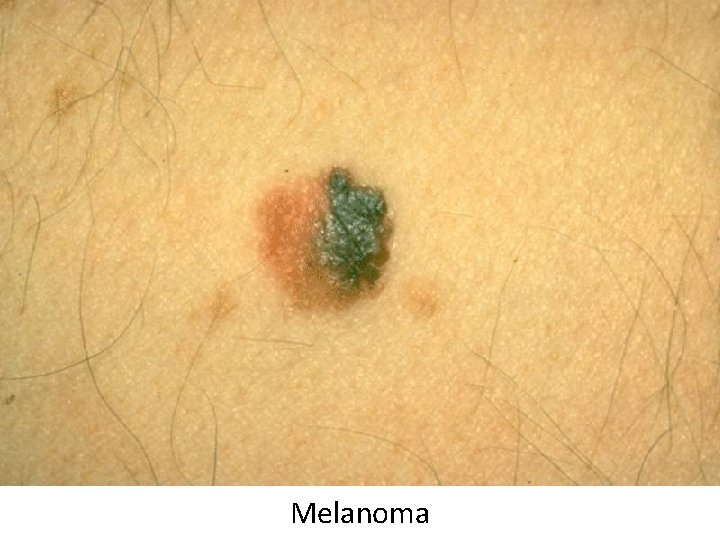Melanoma 