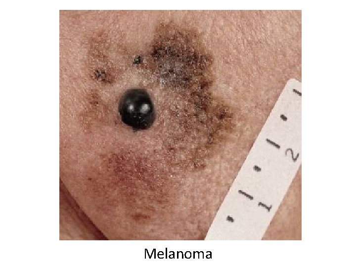 Melanoma 