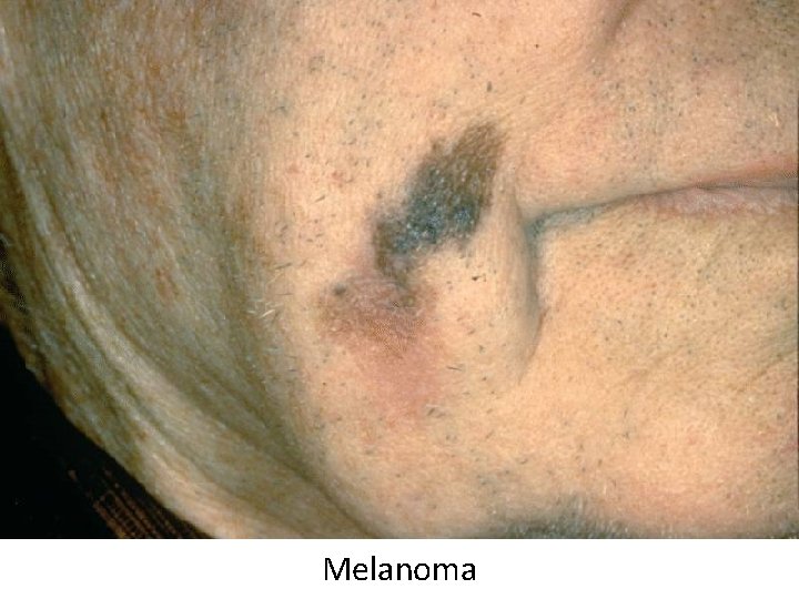 Melanoma 