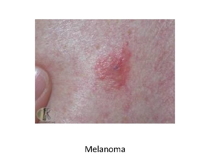 Melanoma 