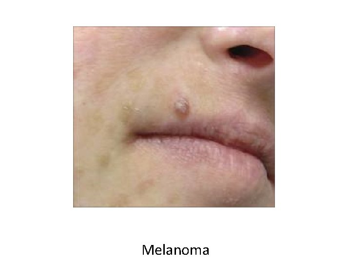 Melanoma 