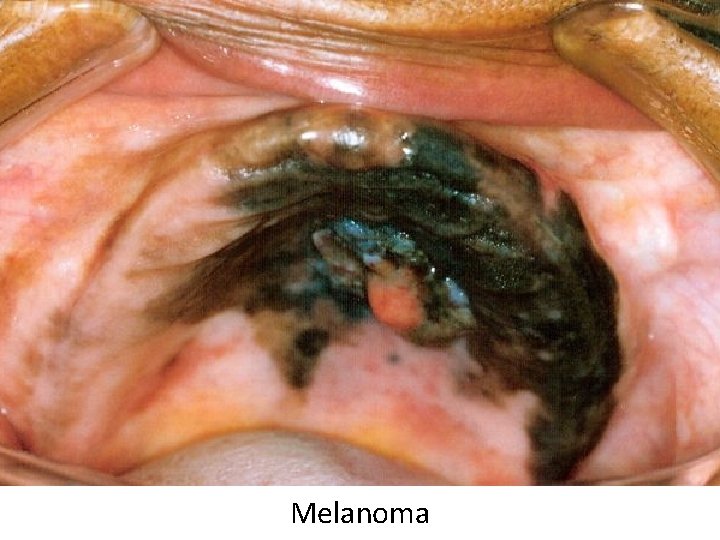 Melanoma 