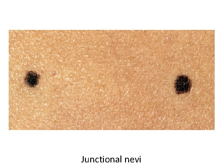Junctional nevi 