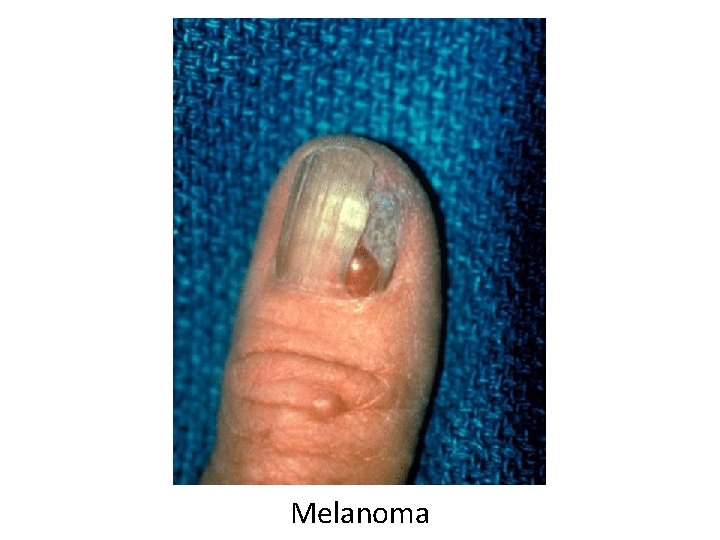 Melanoma 