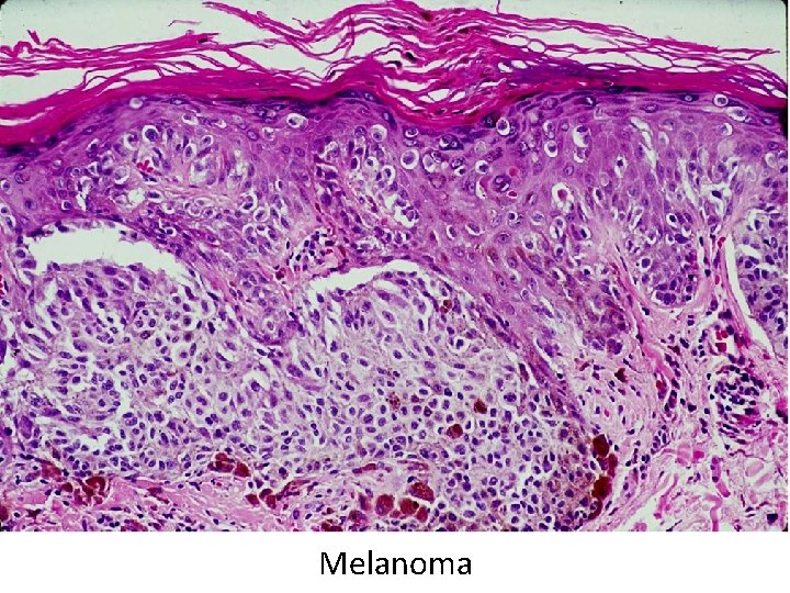 Melanoma 