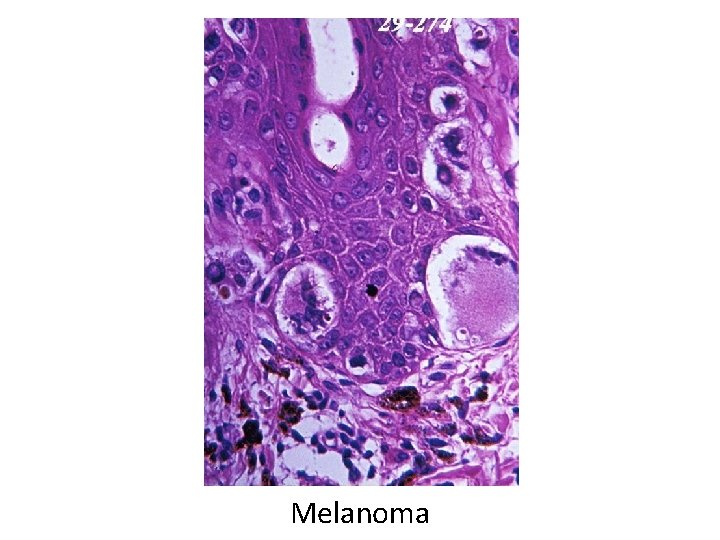Melanoma 