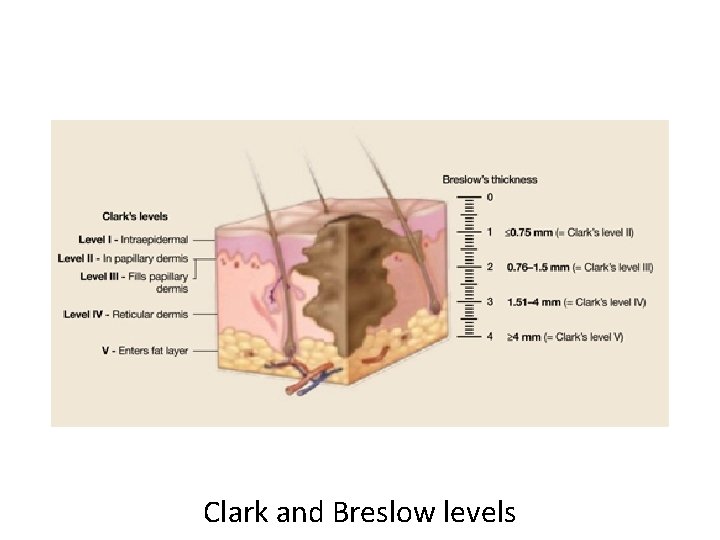 Clark and Breslow levels 