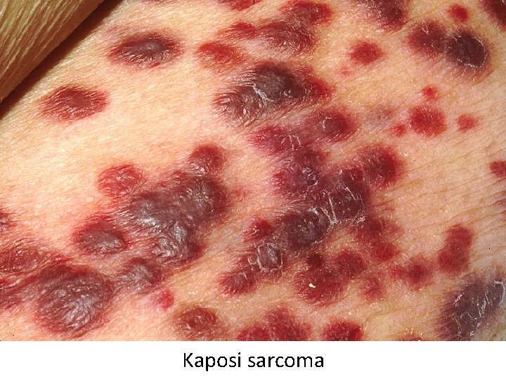 Kaposi sarcoma 