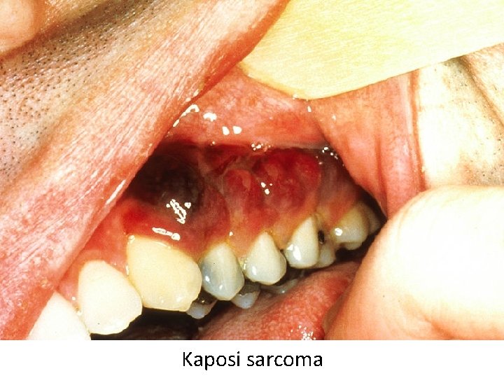 Kaposi sarcoma 