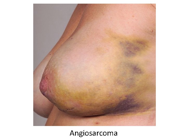 Angiosarcoma 