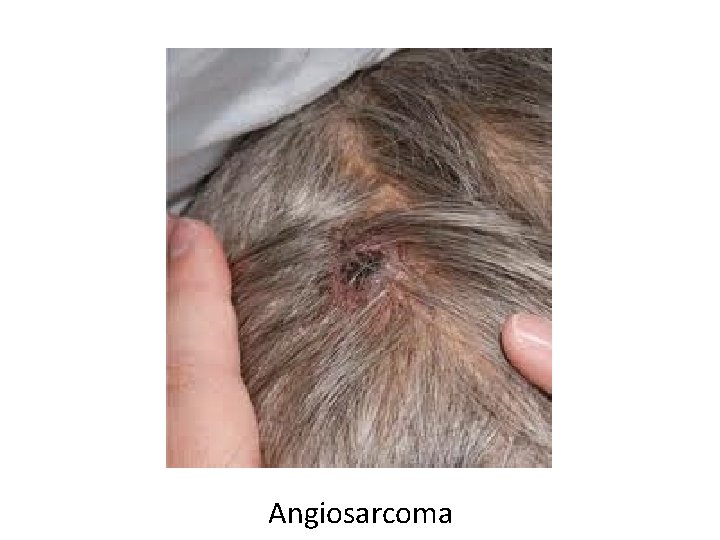Angiosarcoma 