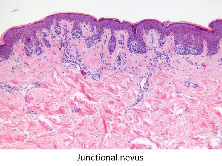 Junctional nevus 