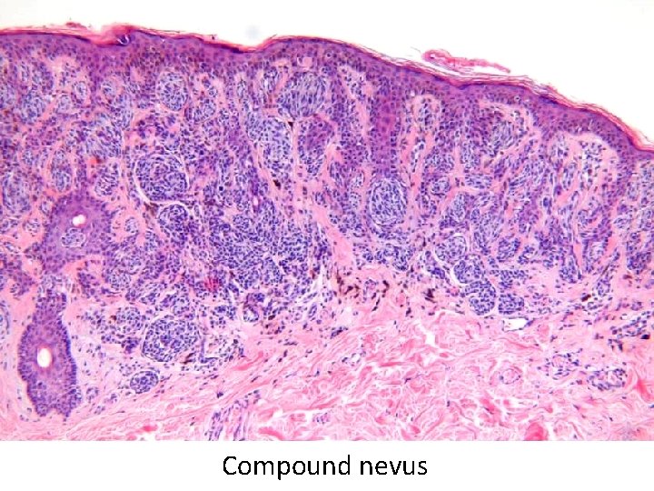 Compound nevus 