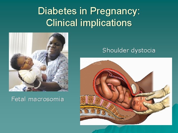 Diabetes in Pregnancy: Clinical implications Shoulder dystocia Fetal macrosomia 