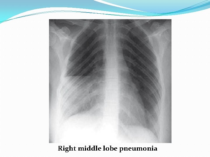 Right middle lobe pneumonia 