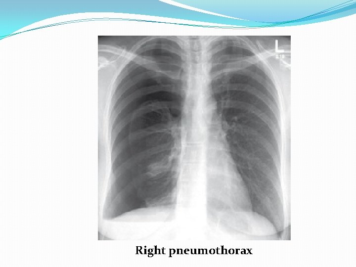 Right pneumothorax 