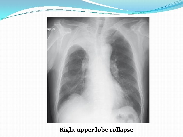 Right upper lobe collapse 