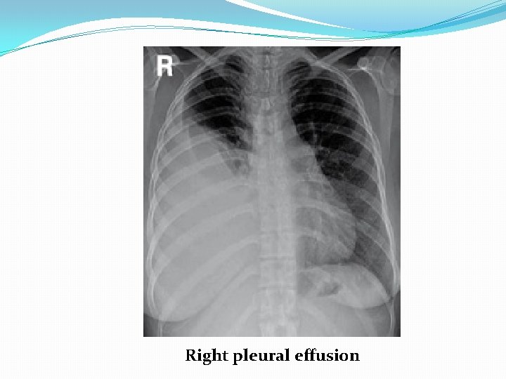 Right pleural effusion 