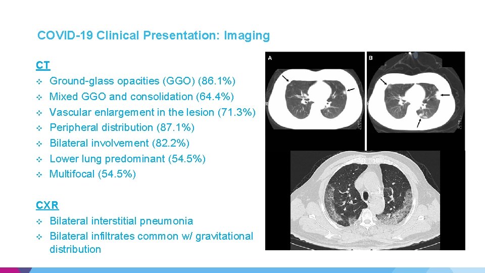COVID-19 Clinical Presentation: Imaging CT v Ground-glass opacities (GGO) (86. 1%) v Mixed GGO COVID-19 Clinical Presentation: Imaging CT v Ground-glass opacities (GGO) (86. 1%) v Mixed GGO