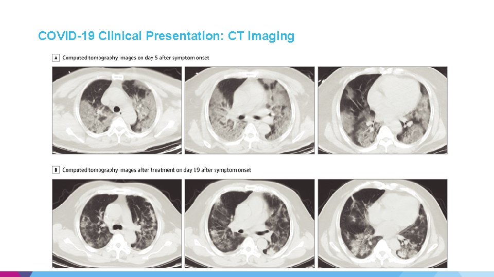 COVID-19 Clinical Presentation: CT Imaging COVID-19 Clinical Presentation: CT Imaging
