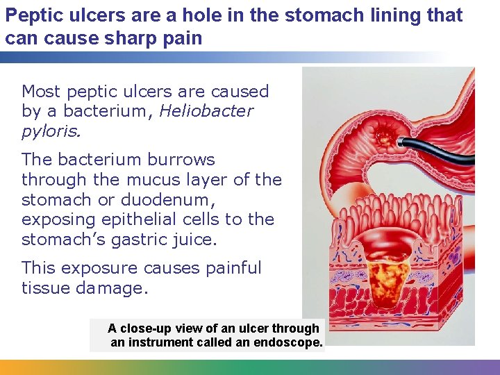 Peptic ulcers are a hole in the stomach lining that can cause sharp pain