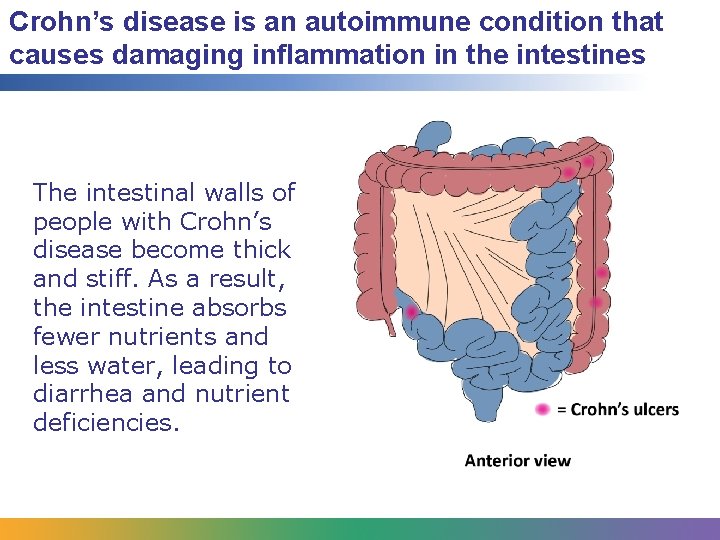 Crohn’s disease is an autoimmune condition that causes damaging inflammation in the intestines The