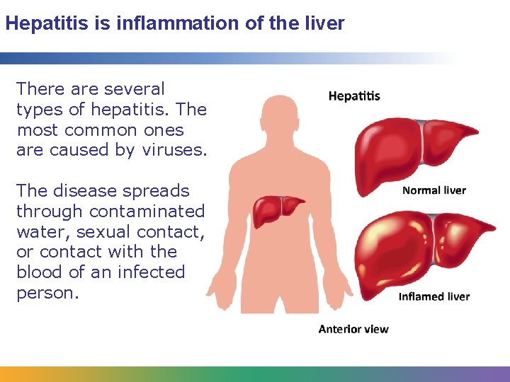 Hepatitis is inflammation of the liver There are several types of hepatitis. The most